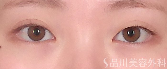 症例NO.71032のBEFORE写真
