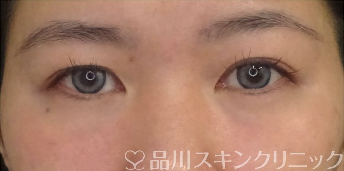 症例NO.69393のAFTER写真