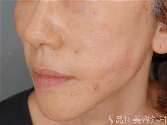 症例NO.53352のAFTER写真