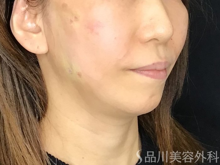 症例NO.69510のAFTER写真