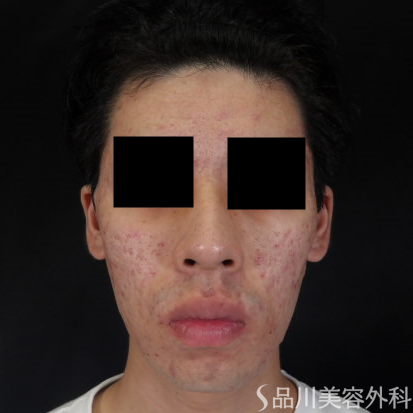 症例NO.74491のBEFORE写真