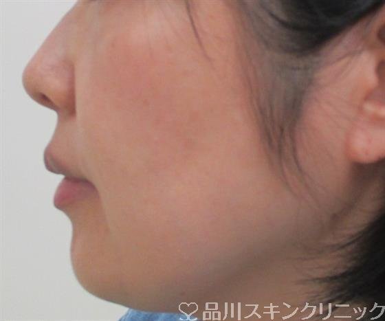 症例NO.25901のBEFORE写真