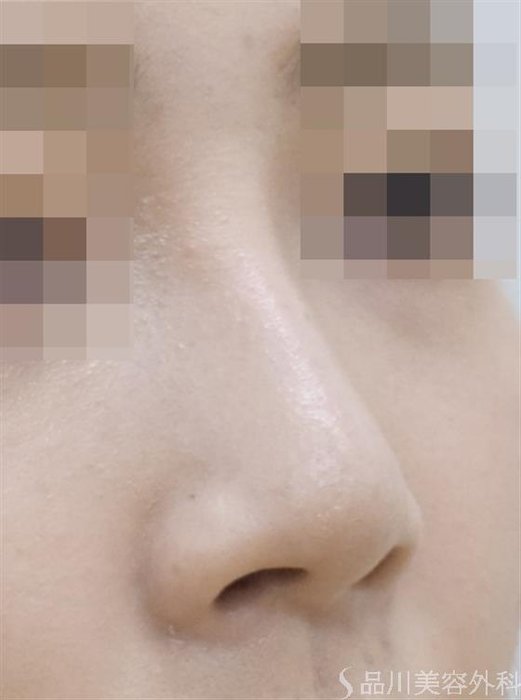 症例NO.51176のAFTER写真