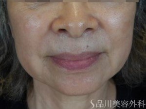 症例NO.74538のBEFORE写真