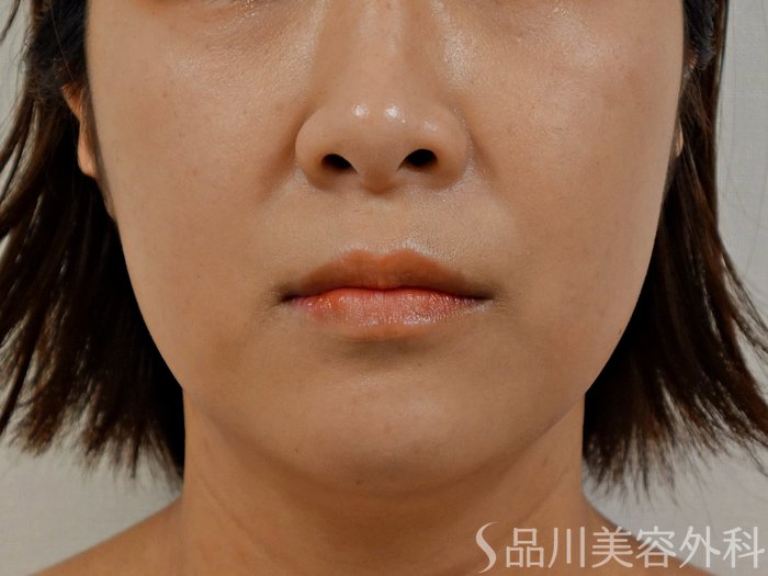 症例NO.73679のBEFORE写真