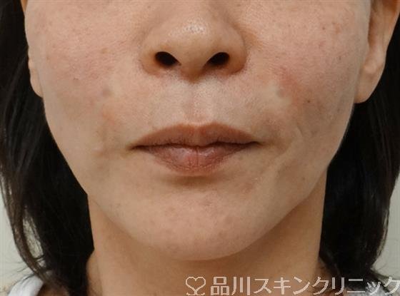 症例NO.42161のAFTER写真