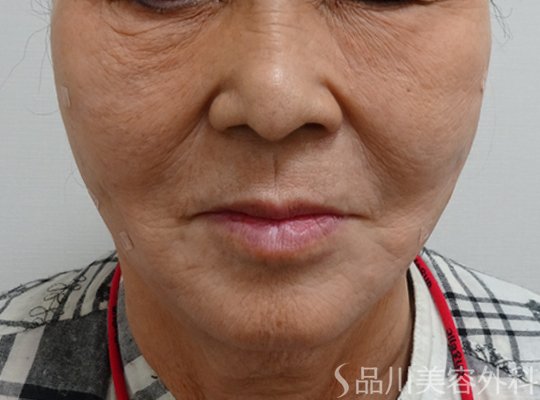 症例NO.72566のAFTER写真