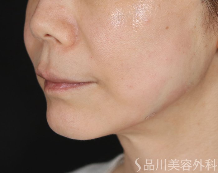 症例NO.73681のAFTER写真