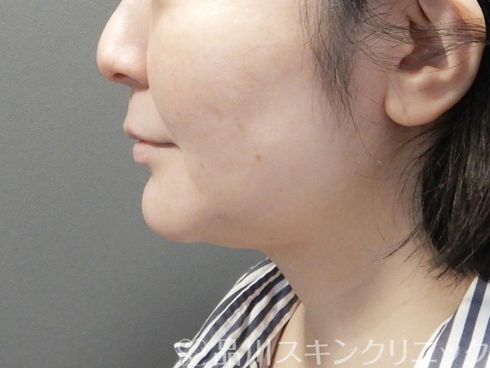 症例NO.73382のAFTER写真