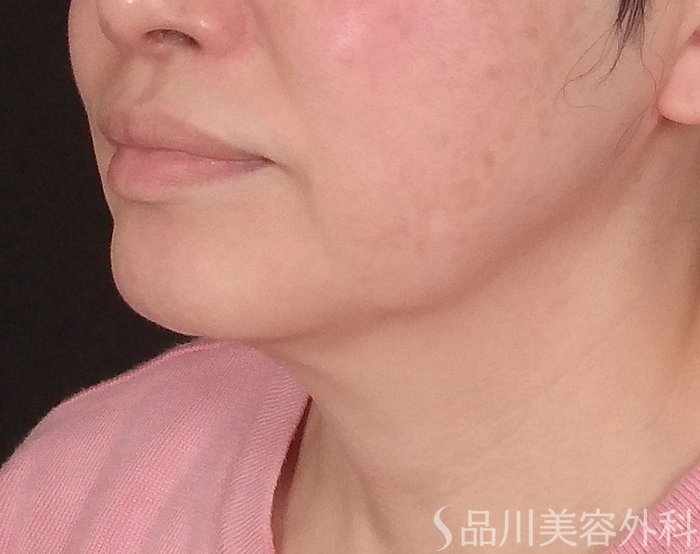 症例NO.70044のBEFORE写真