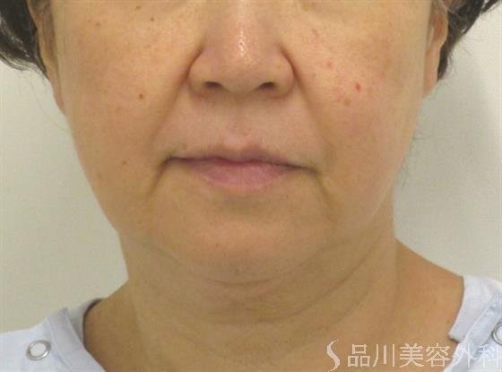 症例NO.45057のBEFORE写真