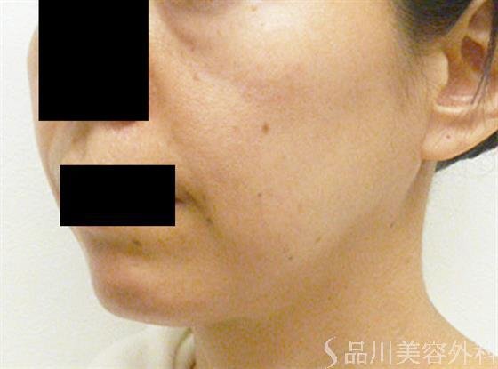 症例NO.24299のBEFORE写真