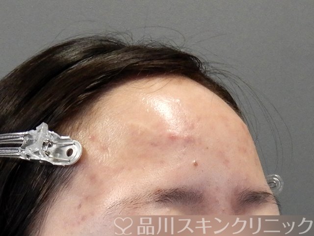 症例NO.69797のAFTER写真