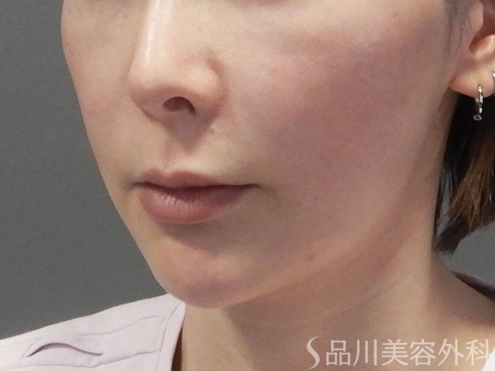 症例NO.70138のBEFORE写真