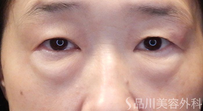 症例NO.70528のBEFORE写真