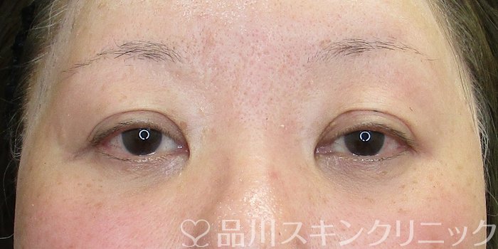 症例NO.74361のBEFORE写真