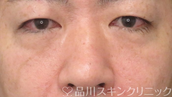 症例NO.70977のBEFORE写真