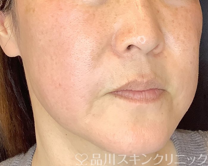 症例NO.69860のBEFORE写真