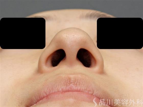 症例NO.57707のBEFORE写真