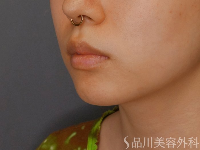 症例NO.70191のBEFORE写真