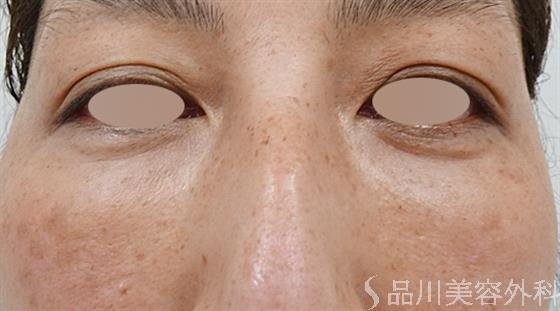 症例NO.50882のAFTER写真
