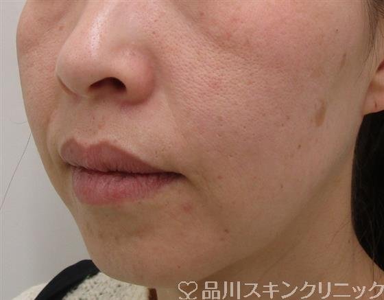 症例NO.53322のBEFORE写真
