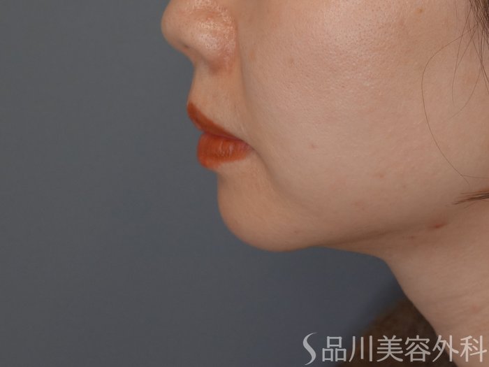 症例NO.72416のBEFORE写真