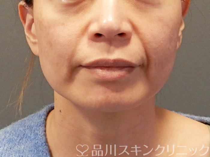 症例NO.63591のBEFORE写真