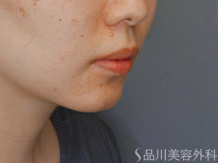 症例NO.71272のBEFORE写真