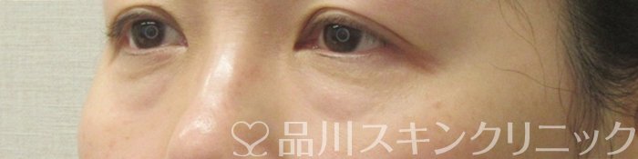 症例NO.71660のBEFORE写真