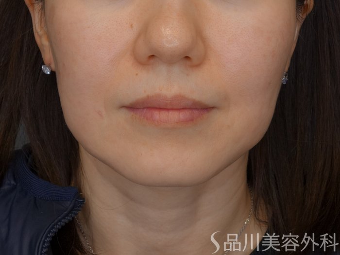 症例NO.74857のBEFORE写真