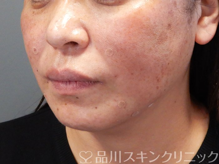 症例NO.69191のAFTER写真