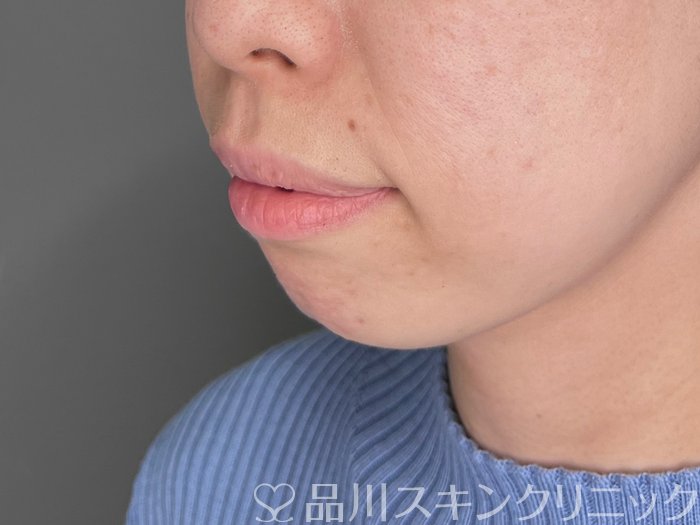 症例NO.69762のBEFORE写真