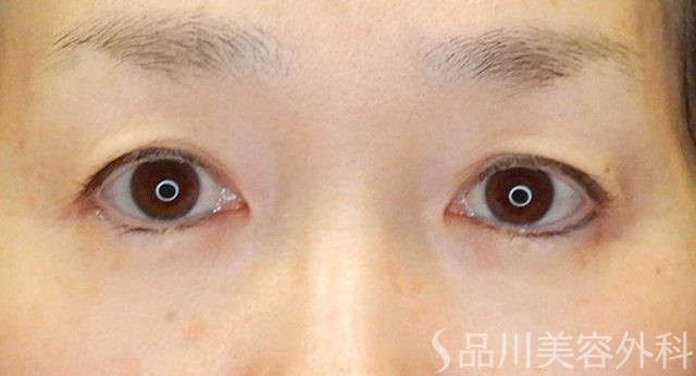 症例NO.65457のBEFORE写真