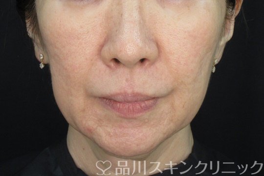 症例NO.72174のBEFORE写真