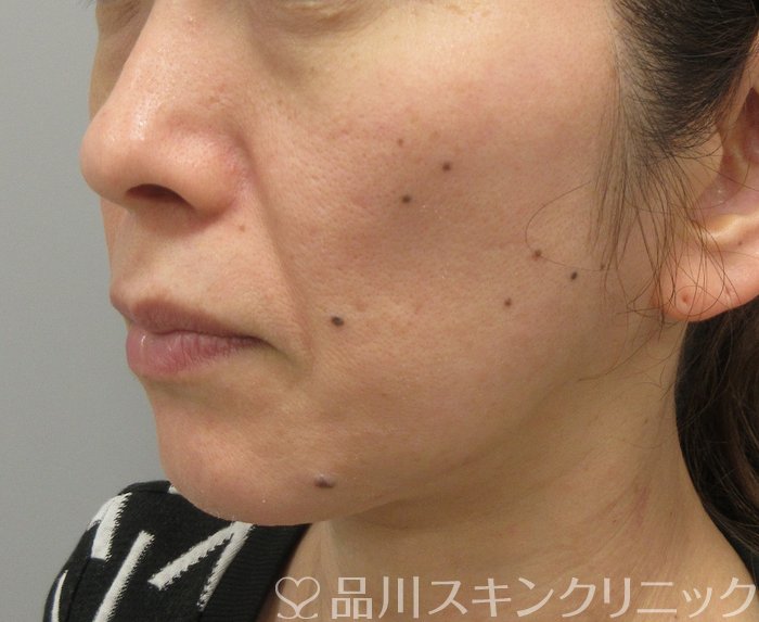 症例NO.74283のBEFORE写真