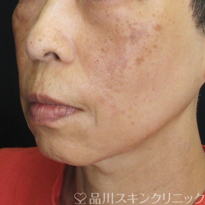 症例NO.74605のAFTER写真