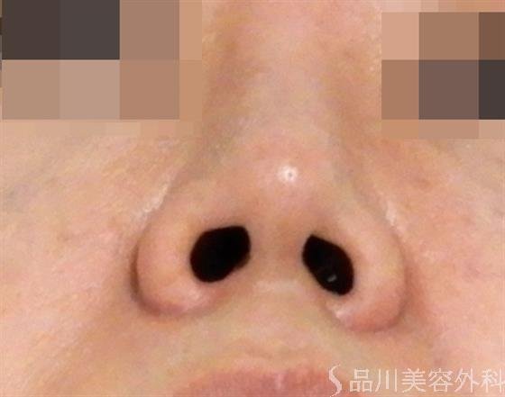 症例NO.42215のAFTER写真
