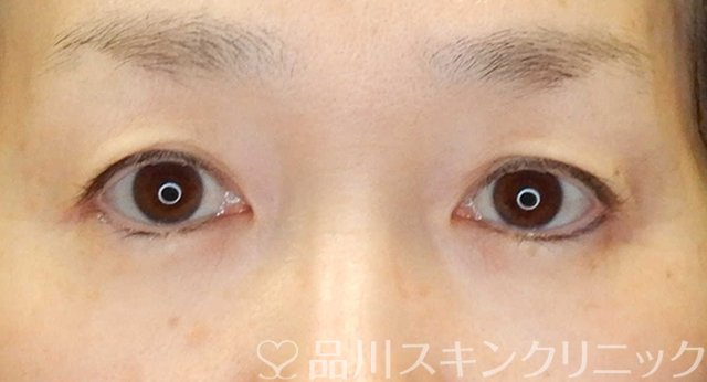 症例NO.65457のBEFORE写真