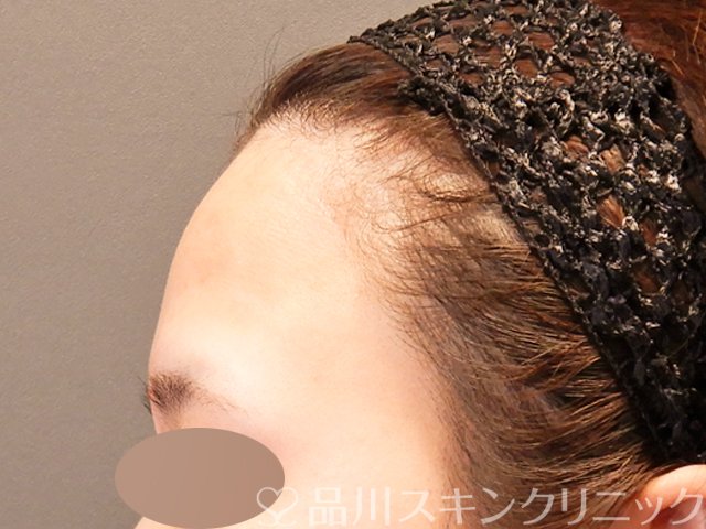 症例NO.70115のBEFORE写真