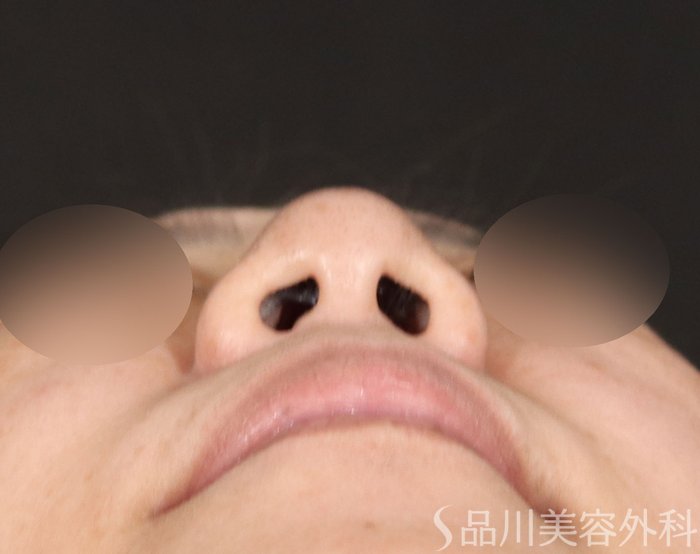 症例NO.72215のBEFORE写真