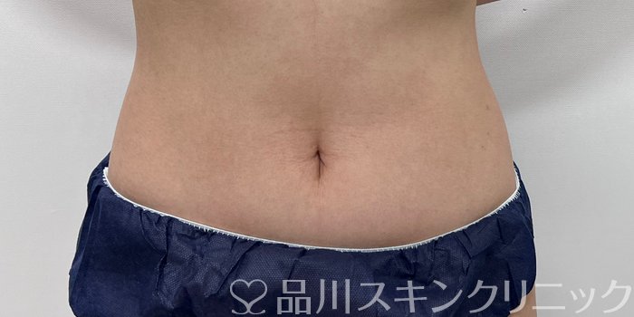 症例NO.69949のAFTER写真