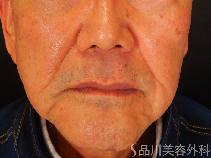 症例NO.68008のBEFORE写真