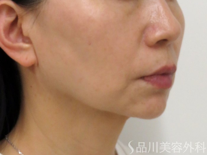 症例NO.73760のAFTER写真