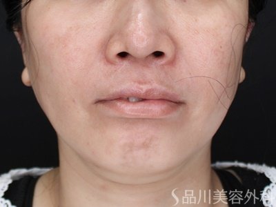 症例NO.71598のAFTER写真