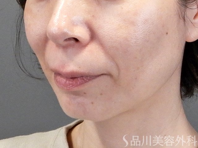 症例NO.69682のBEFORE写真