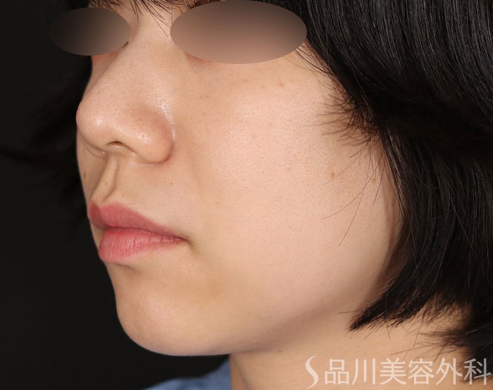 症例NO.71931のBEFORE写真