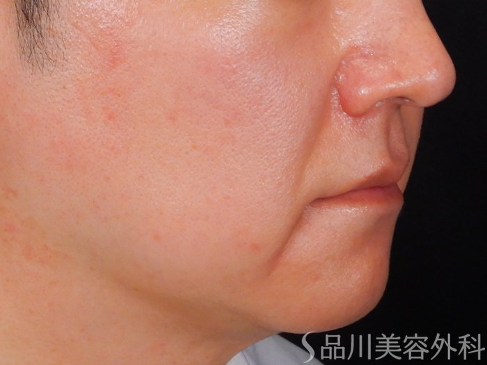 症例NO.67592のBEFORE写真