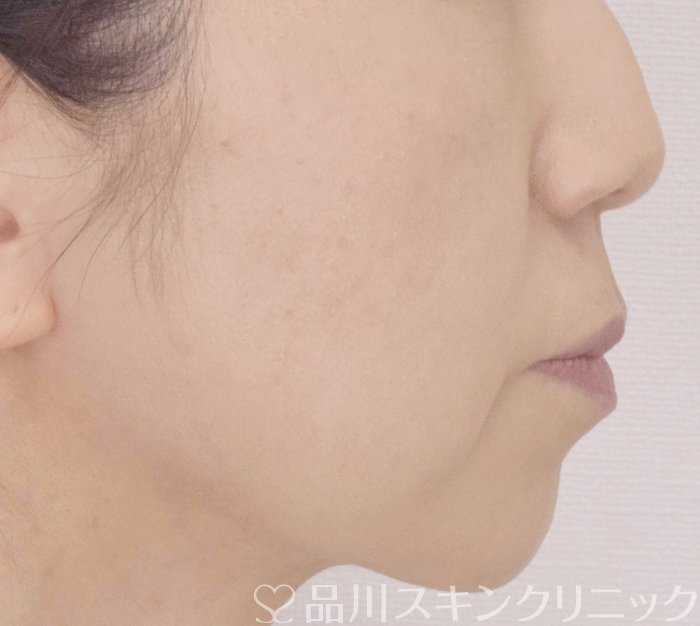 症例NO.72316のBEFORE写真