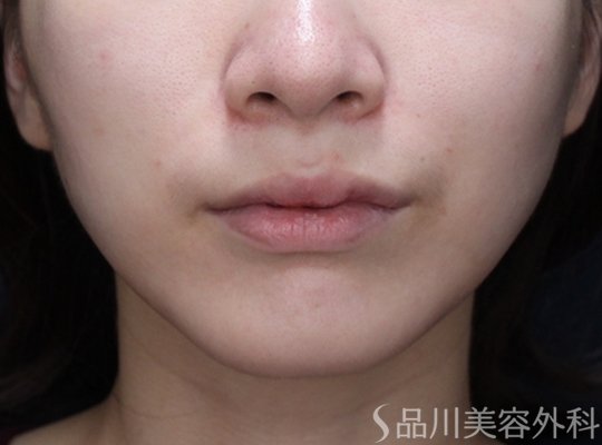 症例NO.73371のAFTER写真